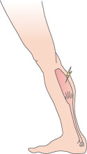 Cramps can be relieved by stretching